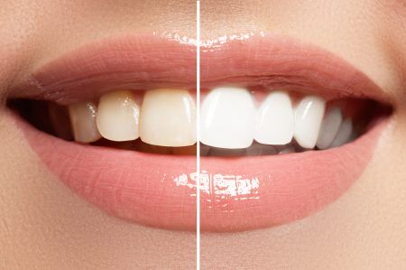 Wybielanie zębów metodą BEYOND w szczegółach